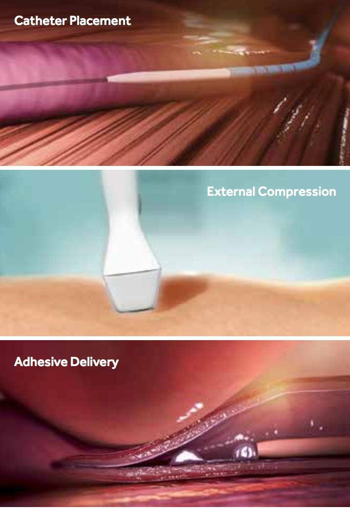 VenaSeal-ClosureSystem